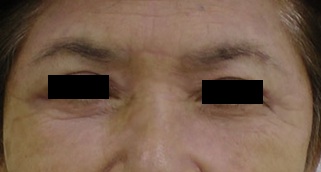 眉間リフト後 黒線あり.jpg