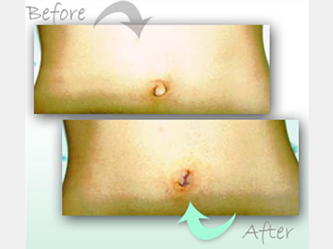navel.jpg