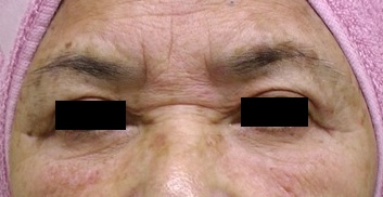 眉間リフト前 黒線あり.jpg